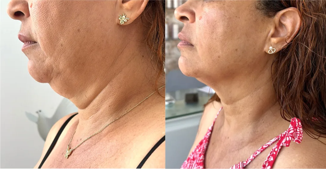 Resultado real cliente 1 - antes y después
