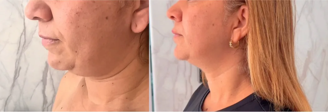 Resultado real cliente 3 - antes y después